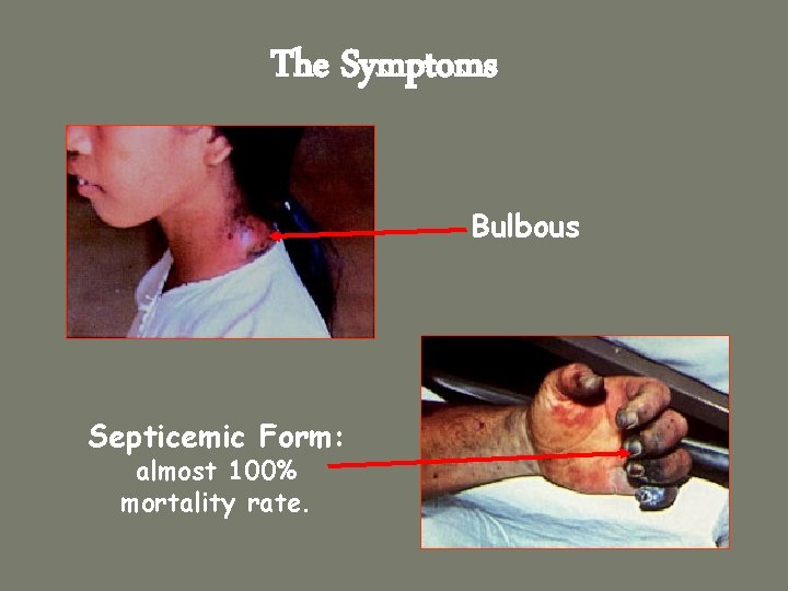 The Symptoms Bulbous Septicemic Form: almost 100% mortality rate. 