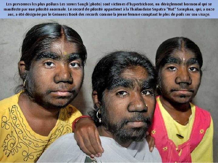 Les personnes les plus poilues Les sœurs Sangli (photo) sont victimes d'hypertrichose, un dérèglement