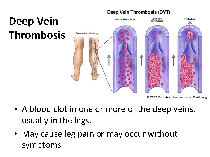 Deep Vein Thrombosis • A blood clot in one or more of the deep