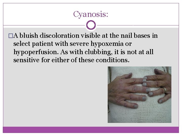 Cyanosis: �A bluish discoloration visible at the nail bases in select patient with severe