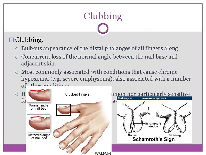 Clubbing � Clubbing: Bulbous appearance of the distal phalanges of all fingers along Concurrent