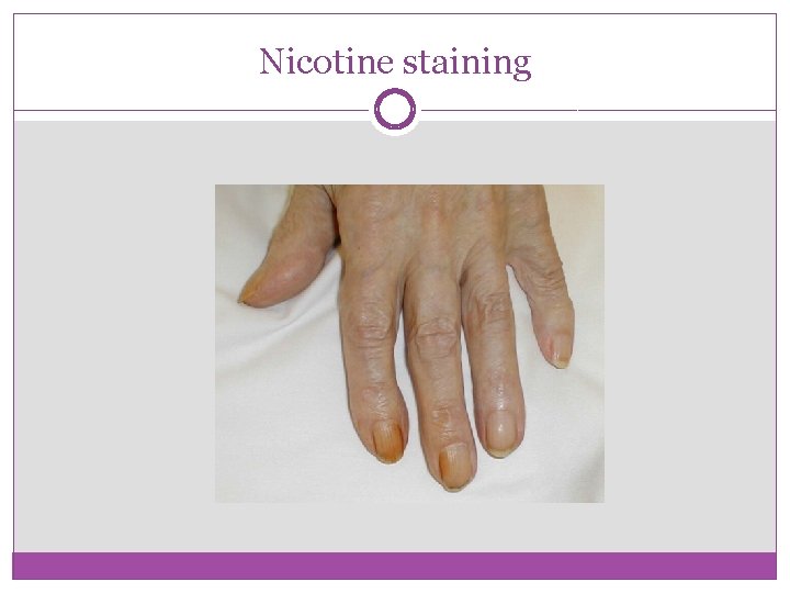 Nicotine staining 