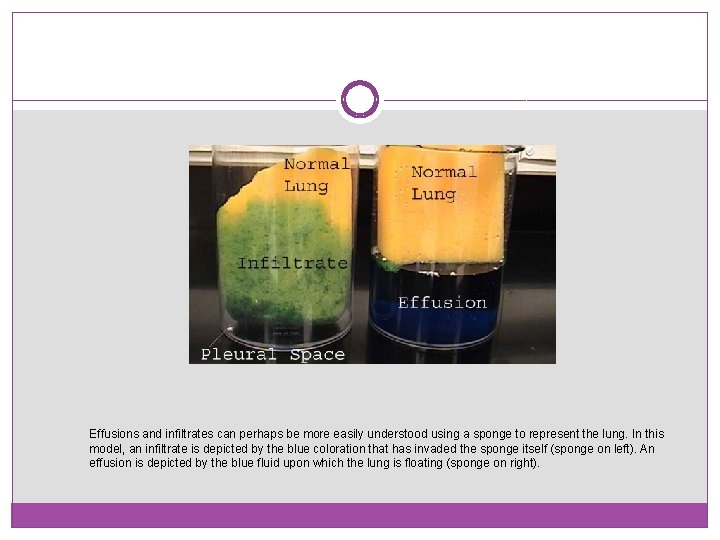 Effusions and infiltrates can perhaps be more easily understood using a sponge to represent