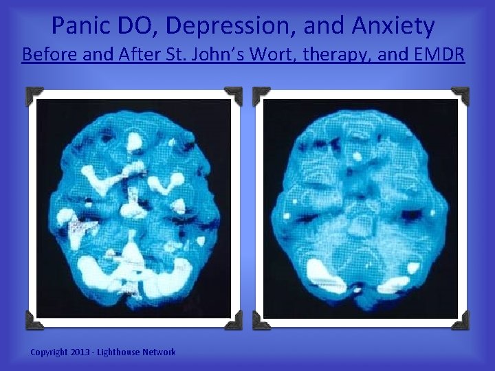 Panic DO, Depression, and Anxiety Before and After St. John’s Wort, therapy, and EMDR