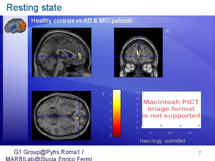 Resting state Healthy controls vs AD & MCI patients R t 5 12 10