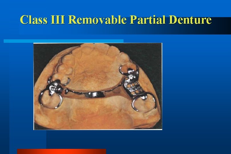 Class III Removable Partial Denture 