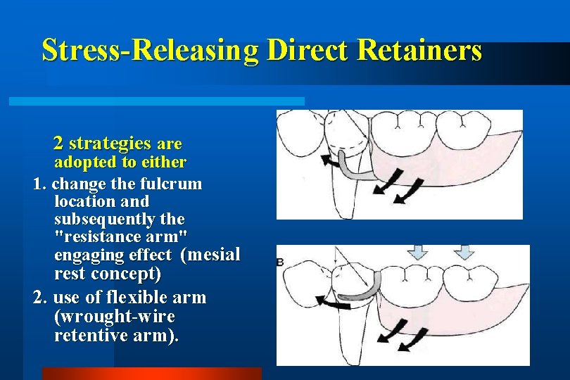 Stress-Releasing Direct Retainers 2 strategies are adopted to either 1. change the fulcrum location