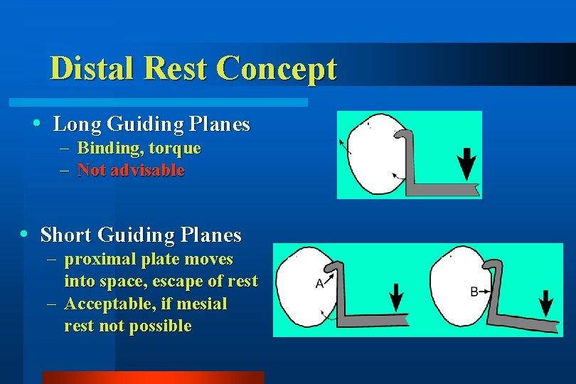 Distal Rest Concept Long Guiding Planes – Binding, torque – Not advisable Short Guiding