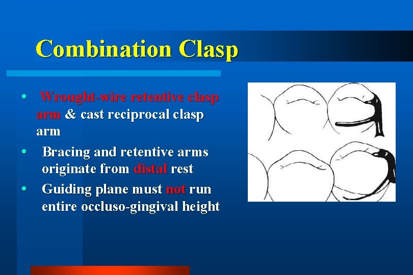 Combination Clasp Wrought-wire retentive clasp arm & cast reciprocal clasp arm Bracing and retentive