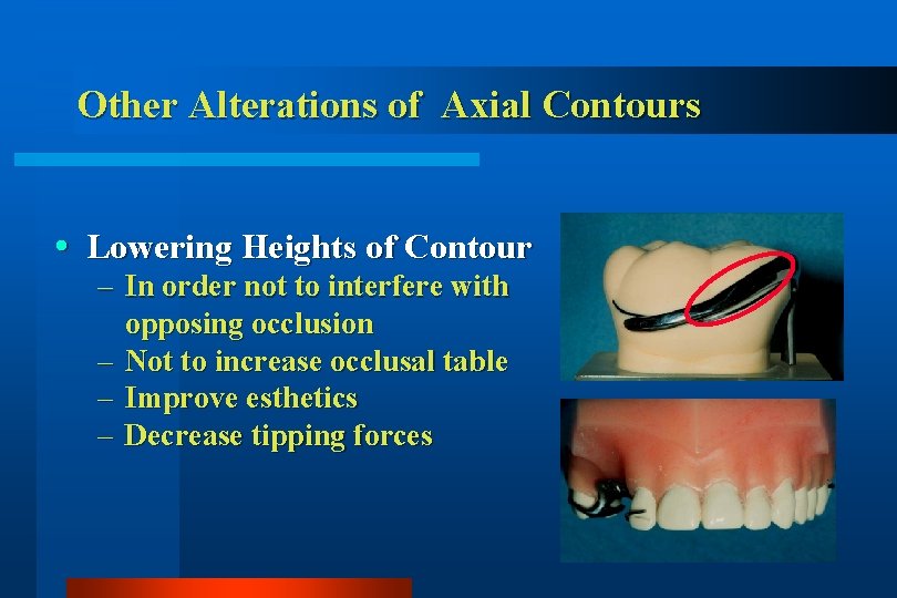 Other Alterations of Axial Contours Lowering Heights of Contour – In order not to