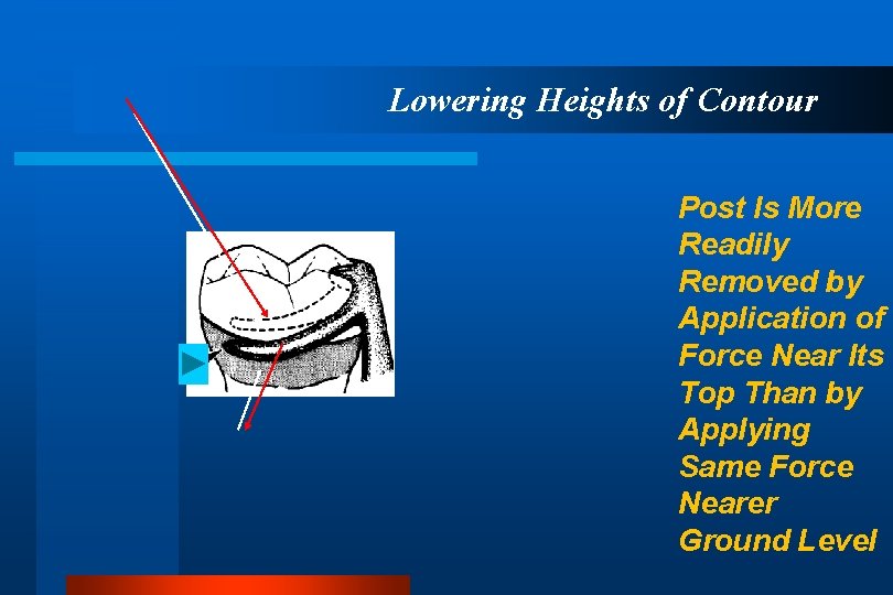 Lowering Heights of Contour Post Is More Readily Removed by Application of Force Near