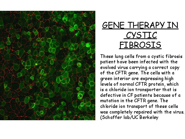 GENE THERAPY IN CYSTIC FIBROSIS These lung cells from a cystic fibrosis patient have