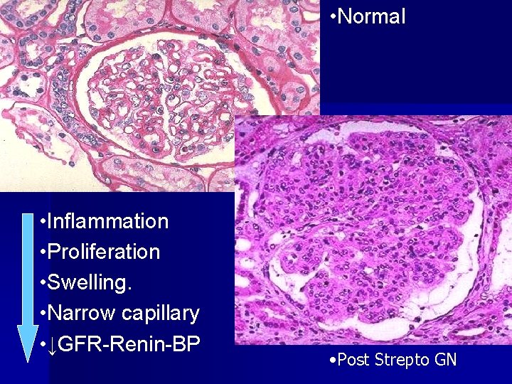  • Normal • Inflammation • Proliferation • Swelling. • Narrow capillary • ↓GFR-Renin-BP