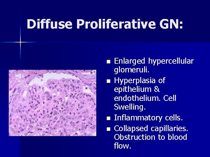 Diffuse Proliferative GN: n n Enlarged hypercellular glomeruli. Hyperplasia of epithelium & endothelium. Cell