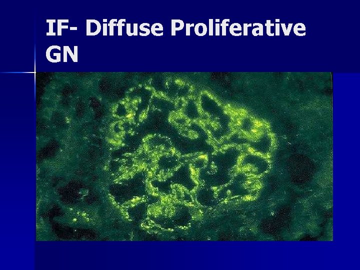 IF- Diffuse Proliferative GN 