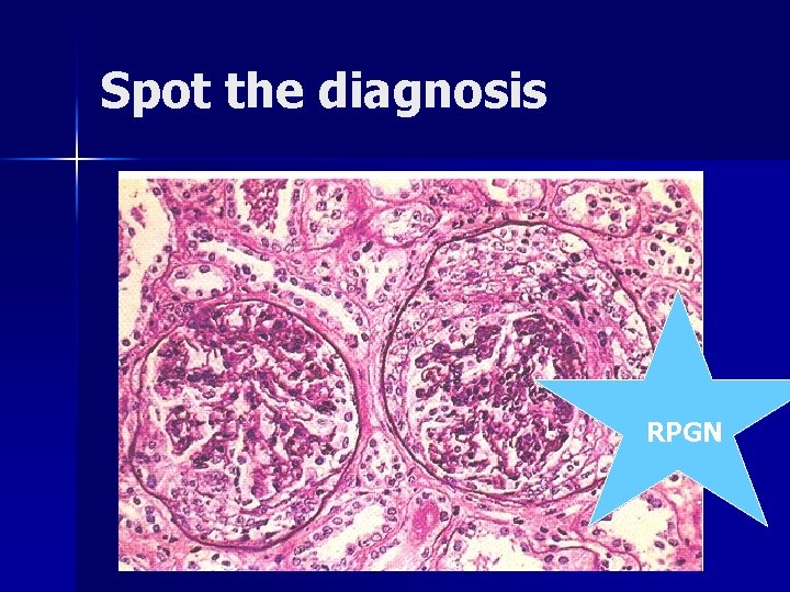 Spot the diagnosis RPGN 