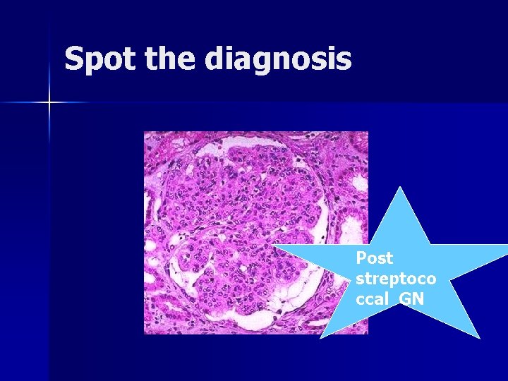 Spot the diagnosis Post streptoco ccal GN 