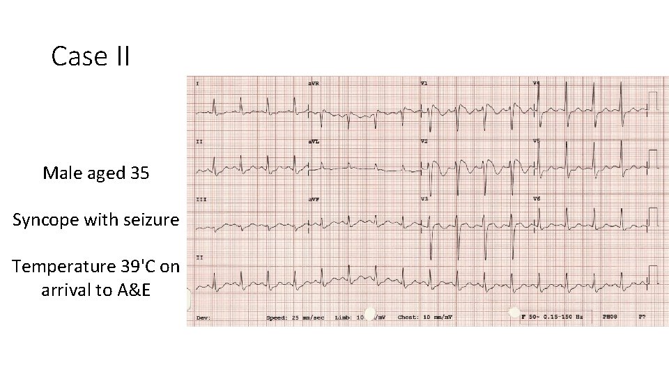 Case II Male aged 35 Syncope with seizure Temperature 39'C on arrival to A&E