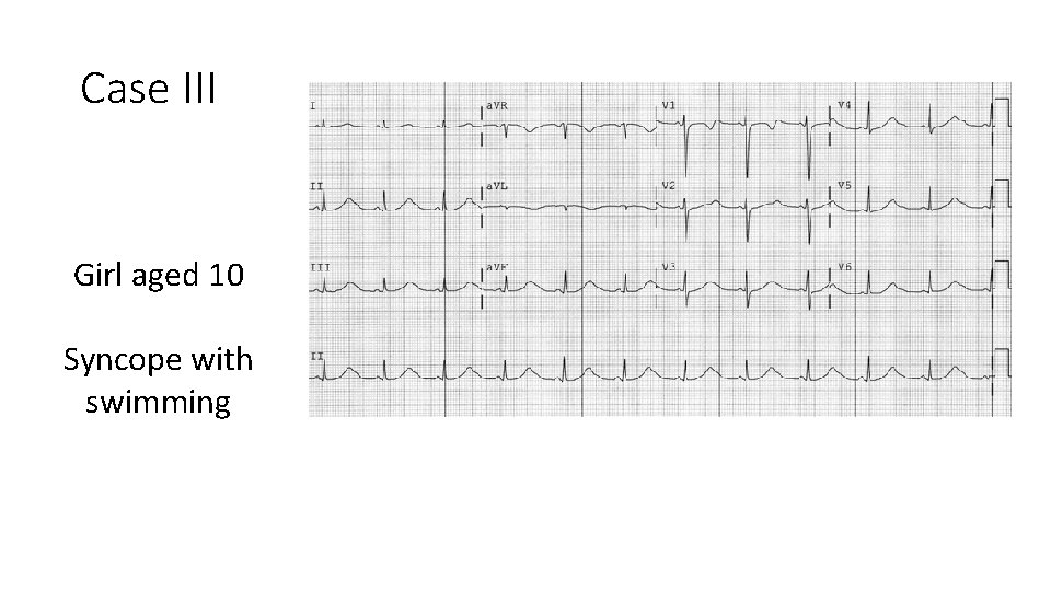 Case III Girl aged 10 Syncope with swimming 