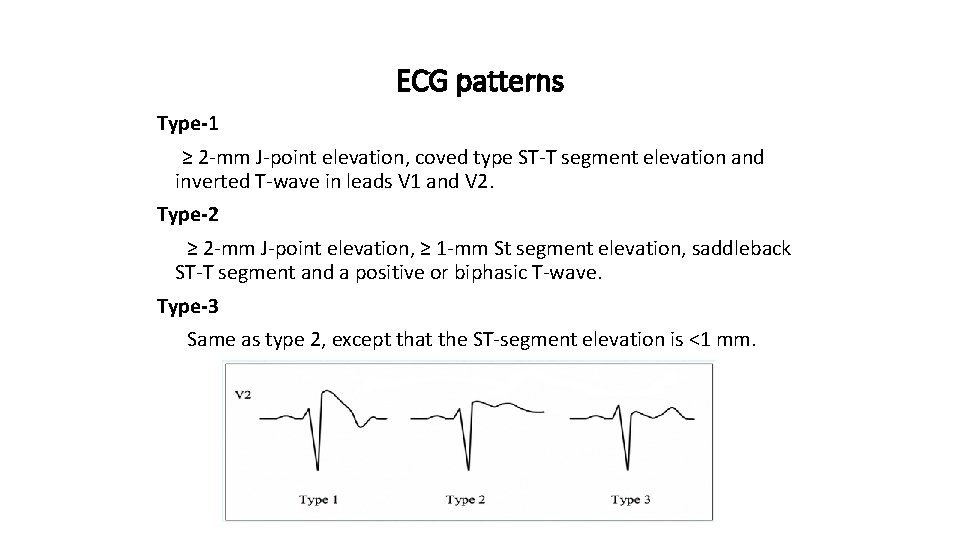 ECG patterns Type-1 ≥ 2 -mm J-point elevation, coved type ST-T segment elevation and