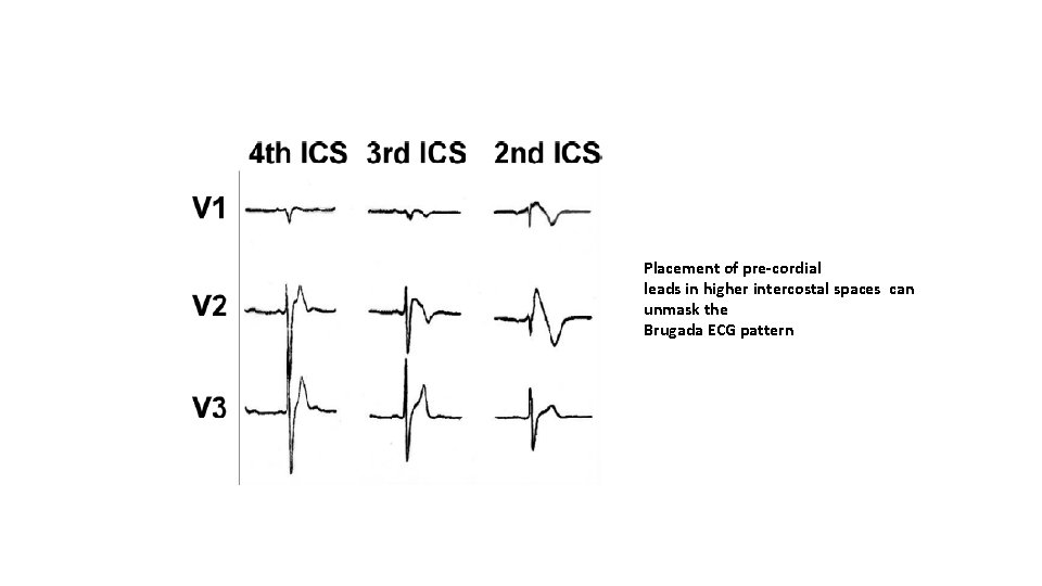 Placement of pre-cordial leads in higher intercostal spaces can unmask the Brugada ECG pattern