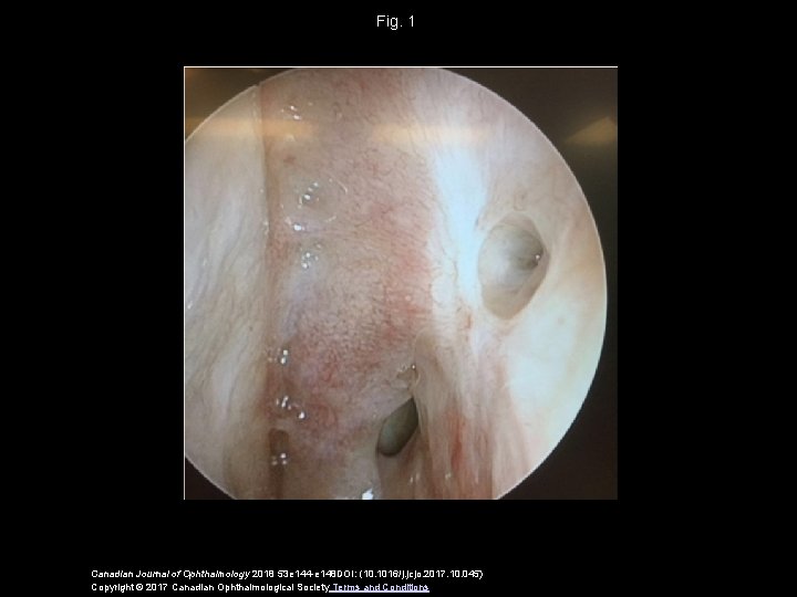 Fig. 1 Canadian Journal of Ophthalmology 2018 53 e 144 -e 148 DOI: (10.