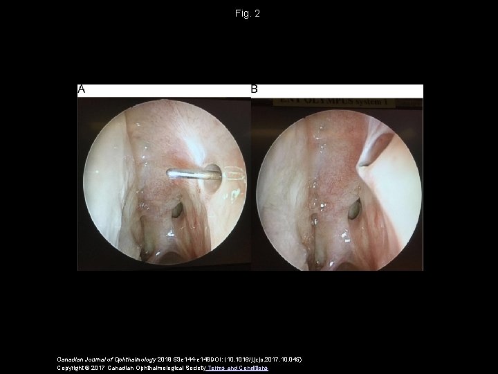 Fig. 2 Canadian Journal of Ophthalmology 2018 53 e 144 -e 148 DOI: (10.