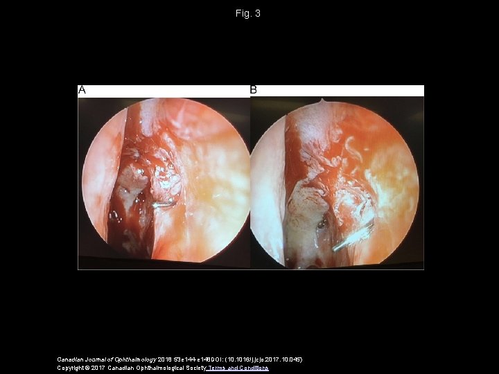 Fig. 3 Canadian Journal of Ophthalmology 2018 53 e 144 -e 148 DOI: (10.