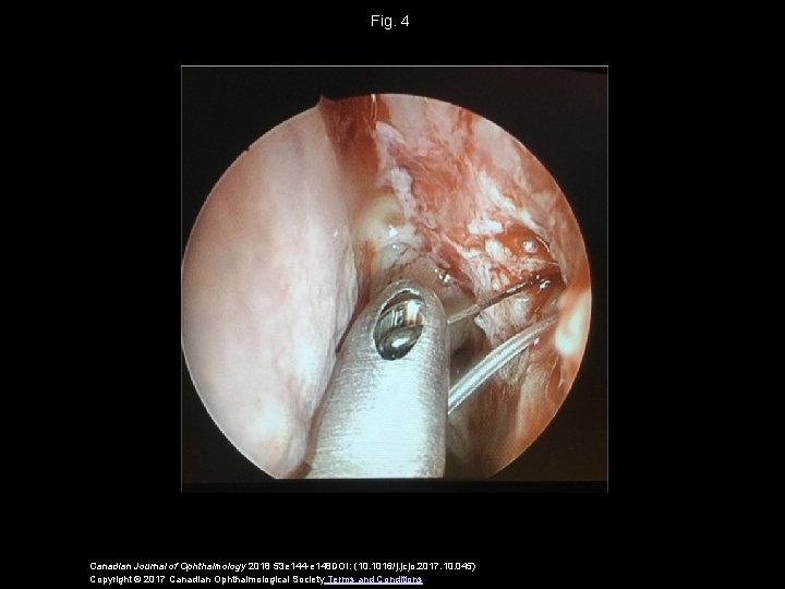 Fig. 4 Canadian Journal of Ophthalmology 2018 53 e 144 -e 148 DOI: (10.