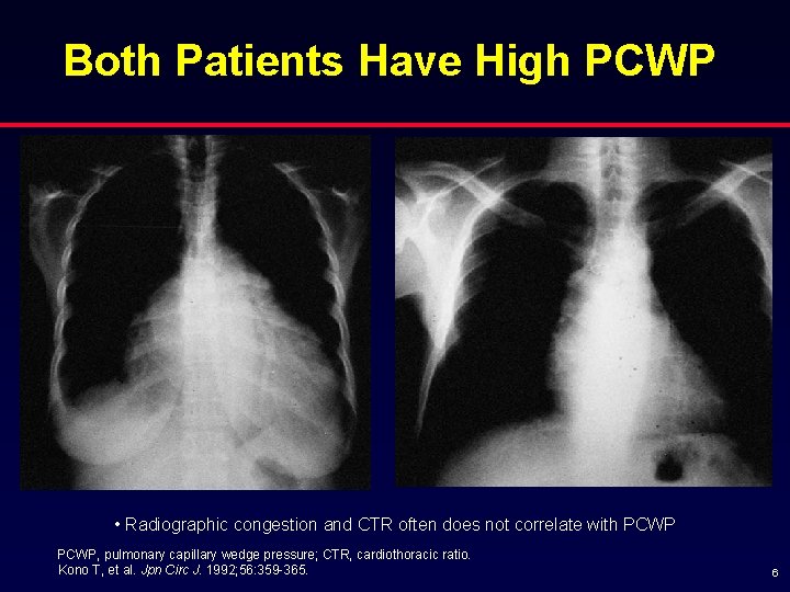 Both Patients Have High PCWP • Radiographic congestion and CTR often does not correlate