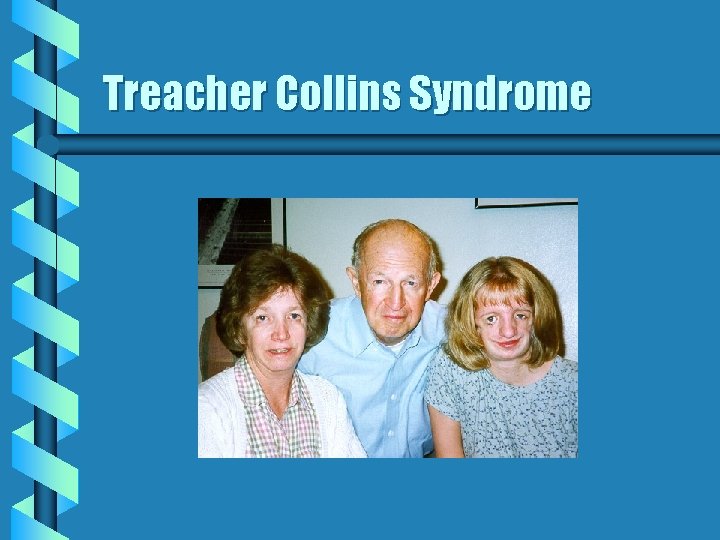 Treacher Collins Syndrome Treacher Collins Syndrome