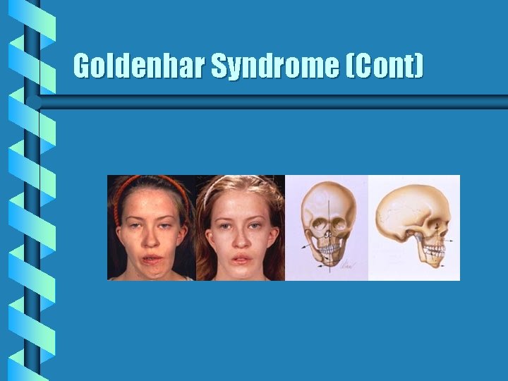 Goldenhar Syndrome (Cont) Goldenhar Syndrome (Cont)