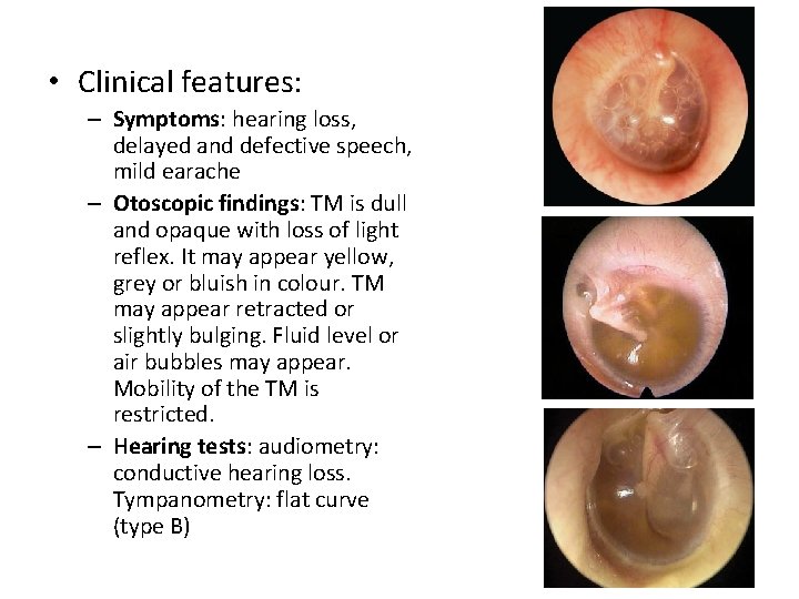  • Clinical features: – Symptoms: hearing loss, delayed and defective speech, mild earache