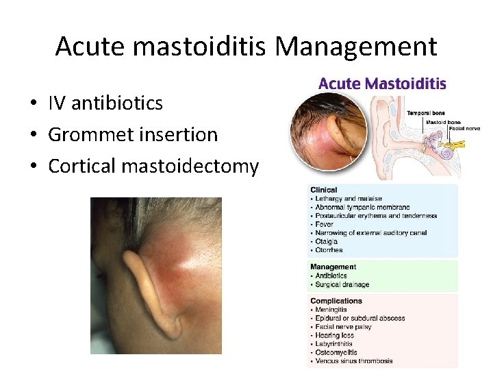 Acute mastoiditis Management • IV antibiotics • Grommet insertion • Cortical mastoidectomy 
