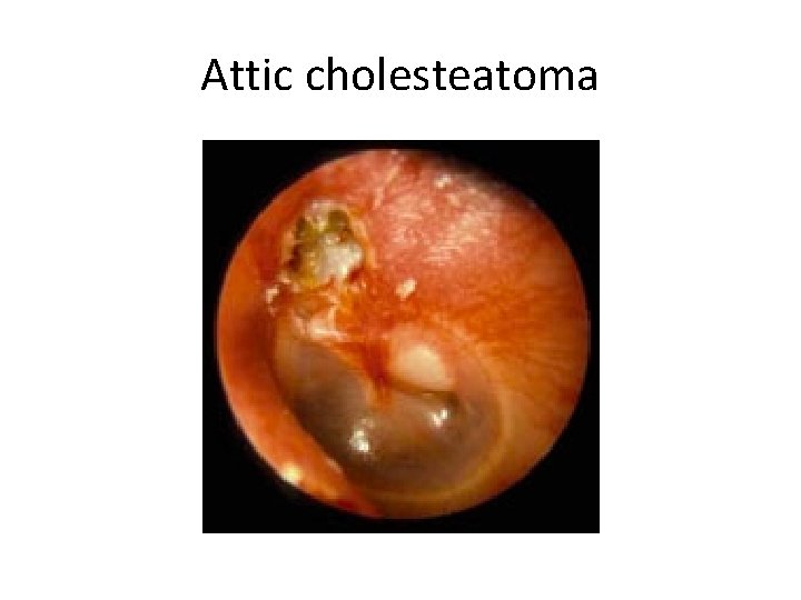 Attic cholesteatoma 
