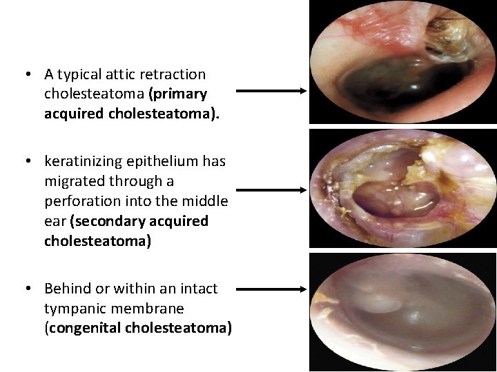  • A typical attic retraction cholesteatoma (primary acquired cholesteatoma). • keratinizing epithelium has