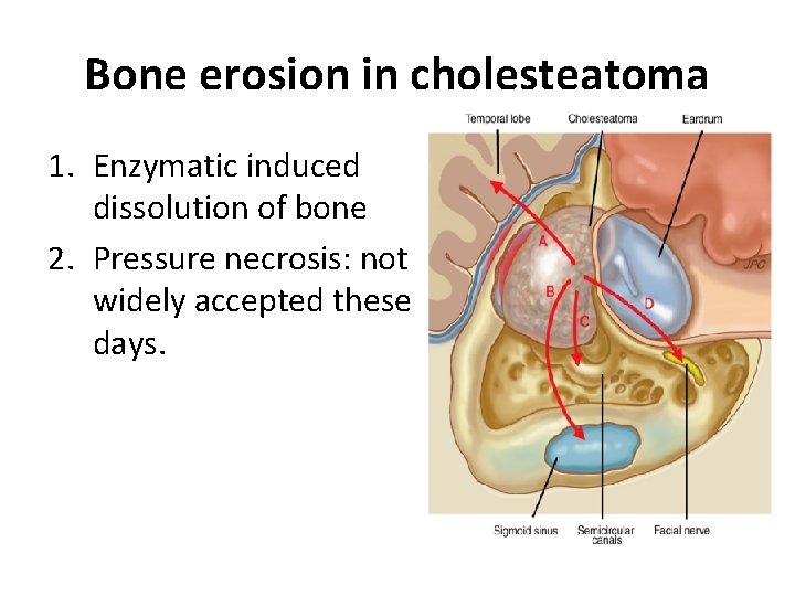 Bone erosion in cholesteatoma 1. Enzymatic induced dissolution of bone 2. Pressure necrosis: not