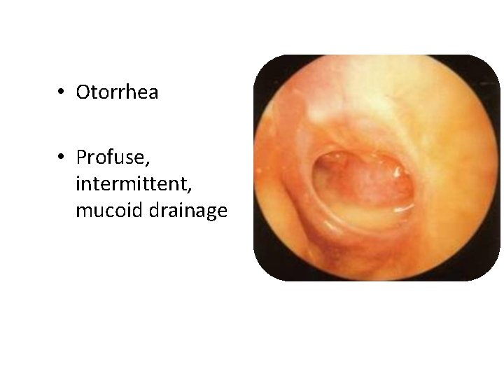  • Otorrhea • Profuse, intermittent, mucoid drainage 