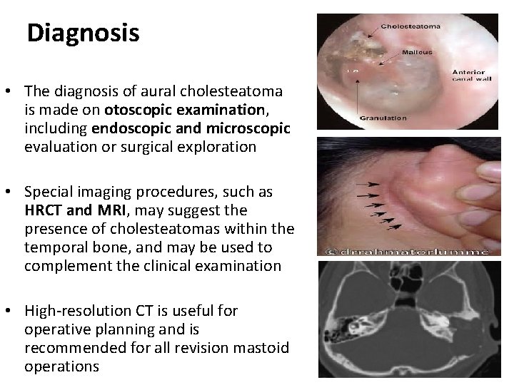 Diagnosis • The diagnosis of aural cholesteatoma is made on otoscopic examination, including endoscopic