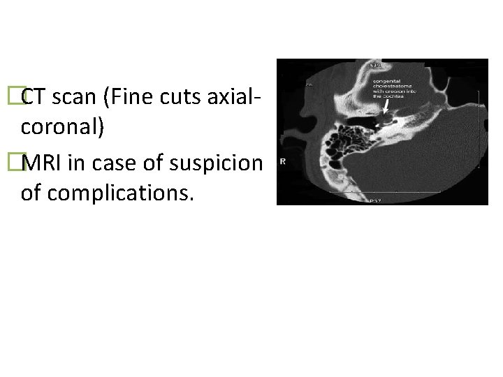 �CT scan (Fine cuts axialcoronal) �MRI in case of suspicion of complications. 