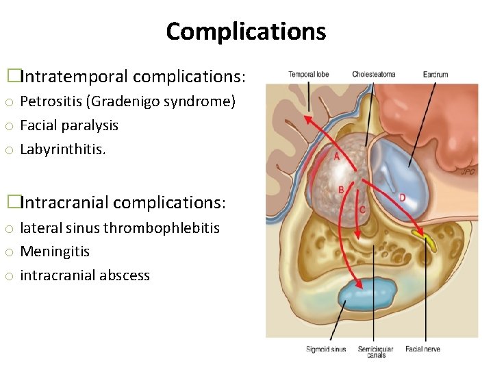 Complications �Intratemporal complications: o Petrositis (Gradenigo syndrome) o Facial paralysis o Labyrinthitis. �Intracranial complications:
