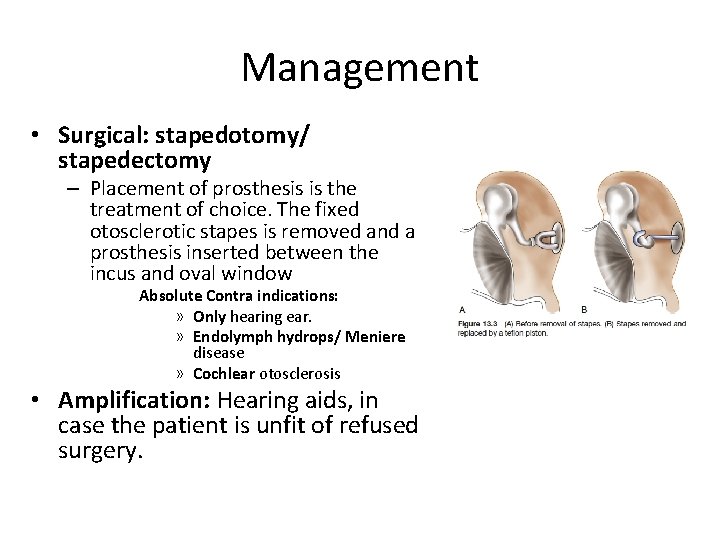 Management • Surgical: stapedotomy/ stapedectomy – Placement of prosthesis is the treatment of choice.