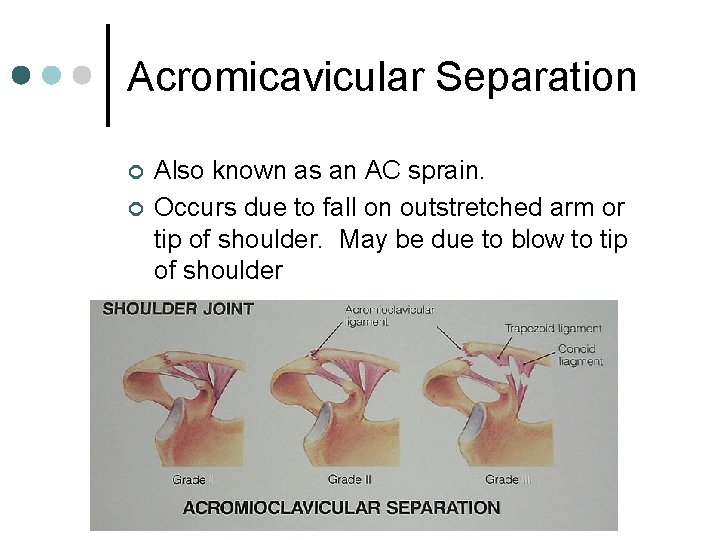 Acromicavicular Separation ¢ ¢ Also known as an AC sprain. Occurs due to fall