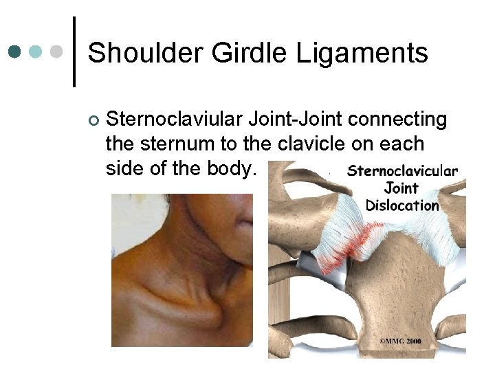 Shoulder Girdle Ligaments ¢ Sternoclaviular Joint-Joint connecting the sternum to the clavicle on each