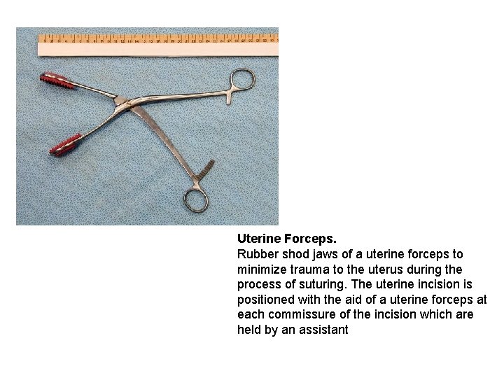 Uterine Forceps. Rubber shod jaws of a uterine forceps to minimize trauma to the