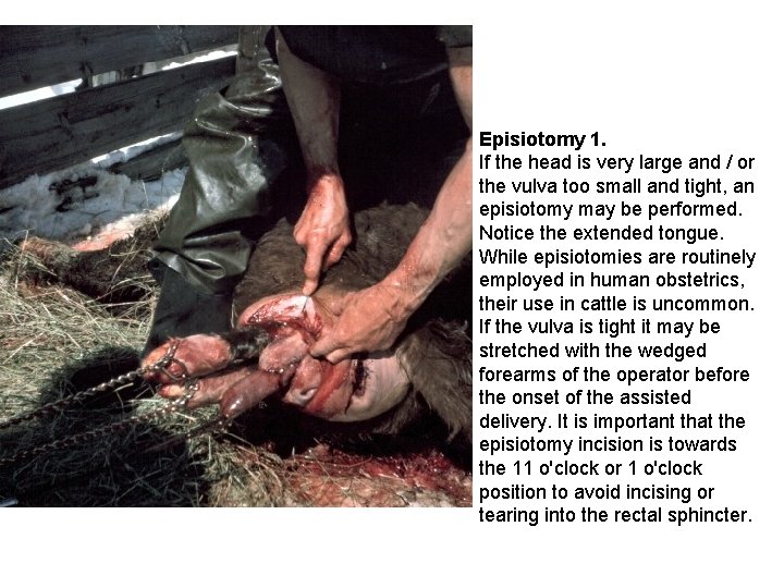 Episiotomy 1. If the head is very large and / or the vulva too