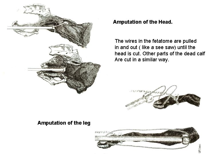 Amputation of the Head. The wires in the fetatome are pulled in and out