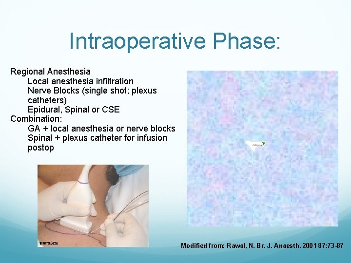 Intraoperative Phase: Regional Anesthesia Local anesthesia infiltration Nerve Blocks (single shot; plexus catheters) Epidural,