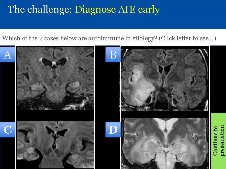 The challenge: Diagnose AIE early A B C D Continue to presentation Which of