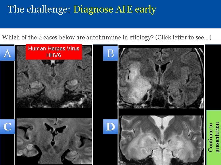 The challenge: Diagnose AIE early Which of the 2 cases below are autoimmune in